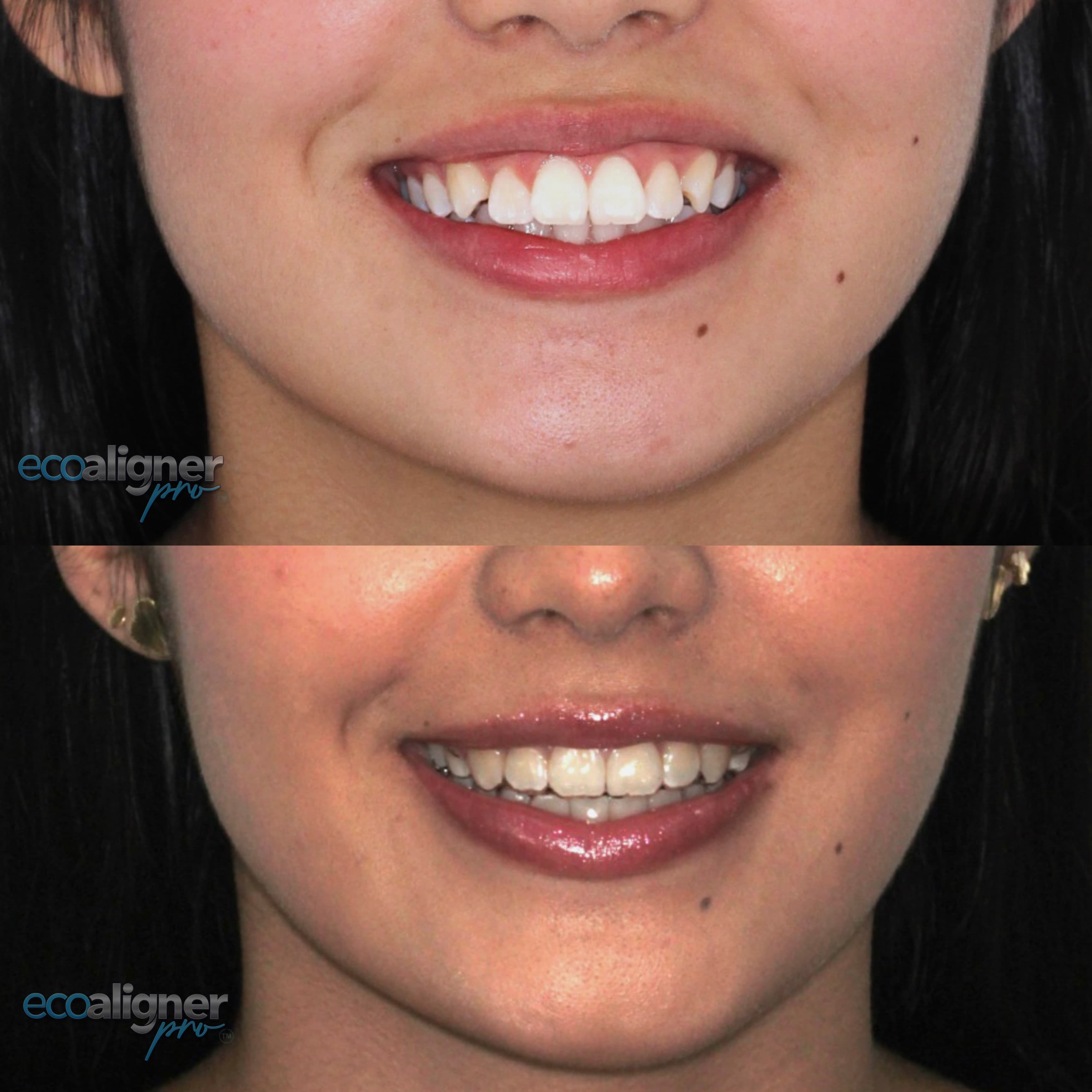 Dos fotografías apiladas del mismo caso: arriba, la sonrisa antes del tratamiento, con los dientes de adelante girados y desalineados; abajo, la misma sonrisa con los dientes alineados.